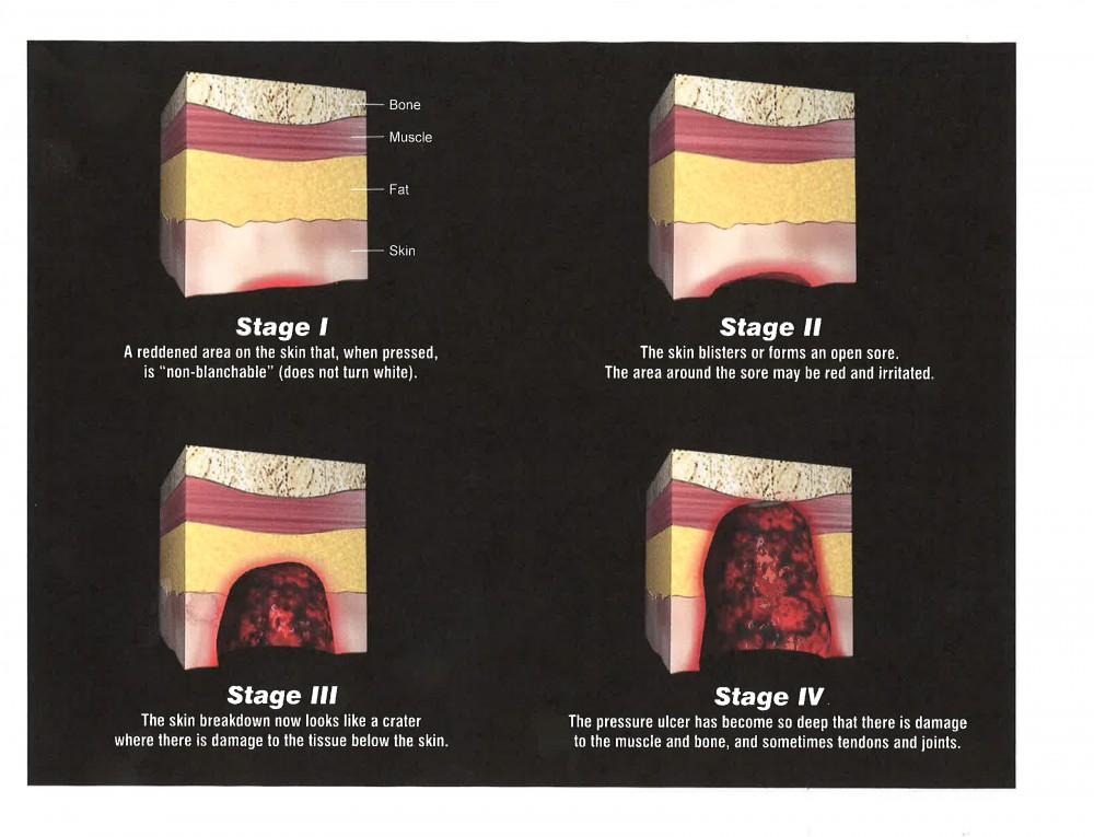 Diabetic Foot Ulcer Stages - Foot and Ankle Podiatrists